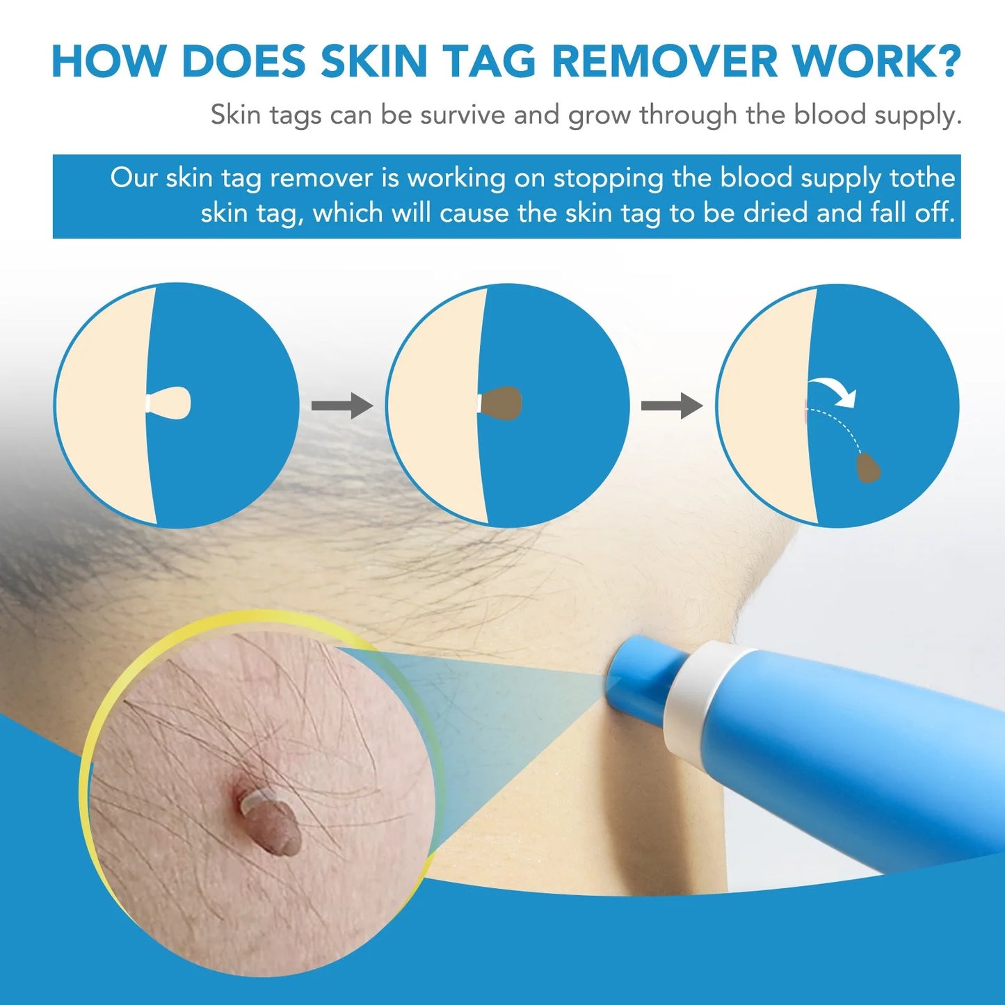 Auto Skin Tag Remover Kit